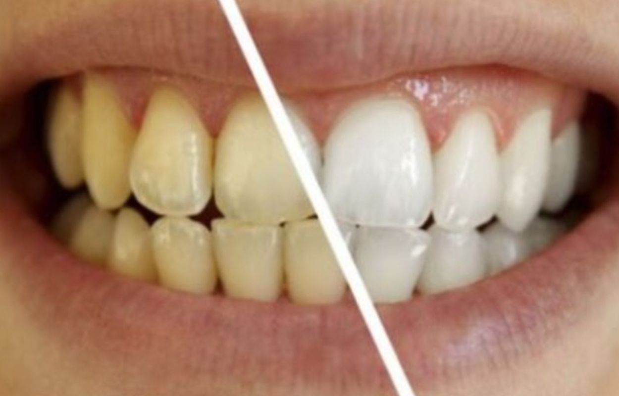 Cara Alami Putihkan Gigi Kuning Bikin Minder Tanpa ke Dokter!