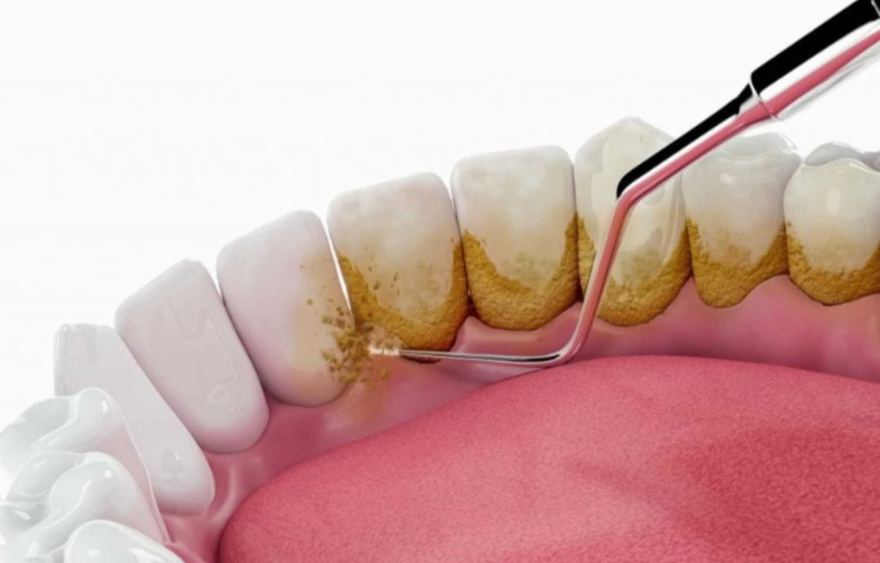 Miliki Gigi Cerah Tanpa Karang Gigi: Pakai Cara Ini Setiap Pagi!