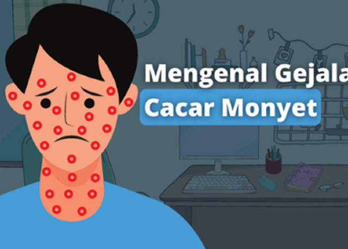 Waspada Cacar Monyet: Kenali Gejala untuk Deteksi dan Penanganan Dini