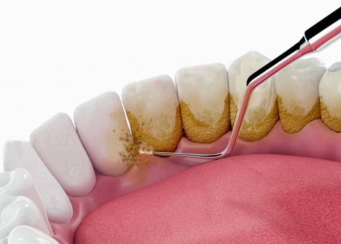 Miliki Gigi Cerah Tanpa Karang Gigi: Pakai Cara Ini Setiap Pagi!