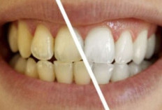 Cara Alami Putihkan Gigi Kuning Bikin Minder Tanpa ke Dokter!