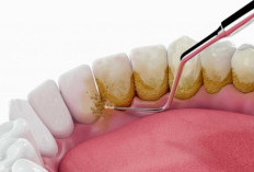 Miliki Gigi Cerah Tanpa Karang Gigi: Pakai Cara Ini Setiap Pagi!